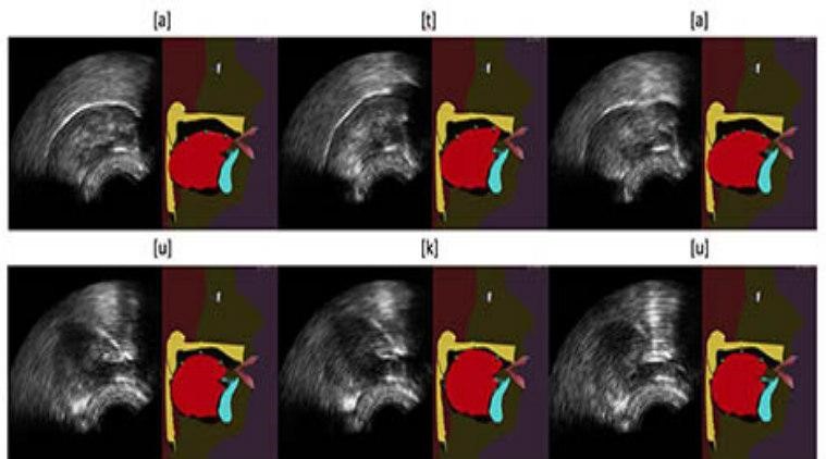 A Revolutionary Leap in Speech Therapy: The Augmented Tongue Ultrasound