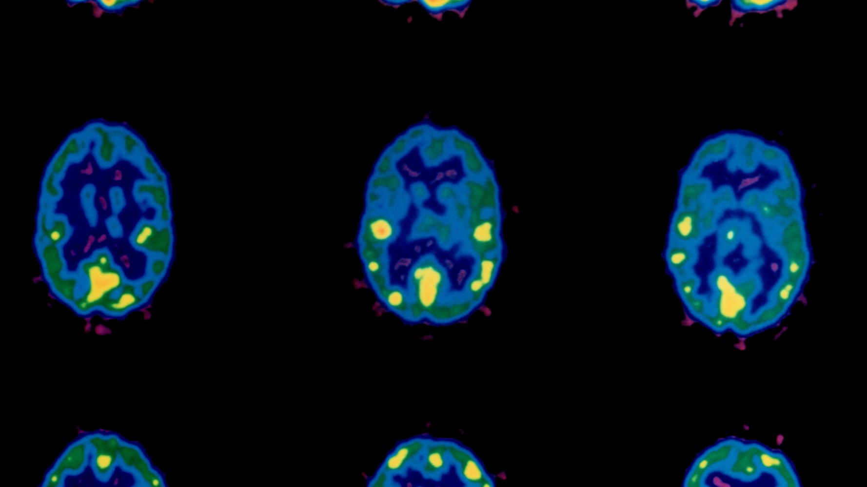 Cocaine On The Brain: Research On Fruit Flies Opens Ground For Therapeutic Impact At Cellular Level