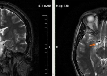 Researchers Develop AI Model That Classifies Brain Tumours With Single MRI Scan